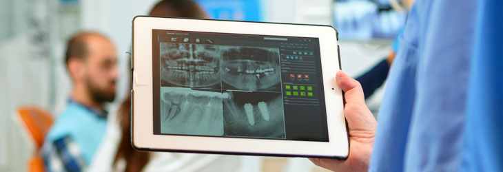 implantes dentales